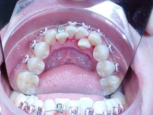 010 B-oclusal 070208