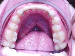 023 B-oclusal 250806