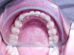 031 0741 B-oclusal 270710